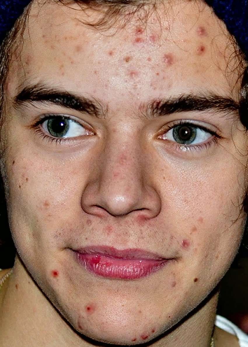 Harry Styles One Direction acne