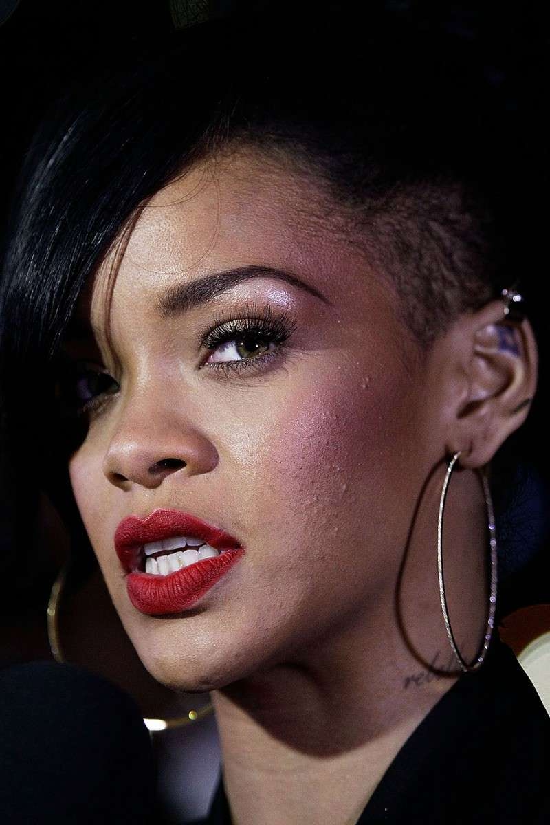 Rihanna acne