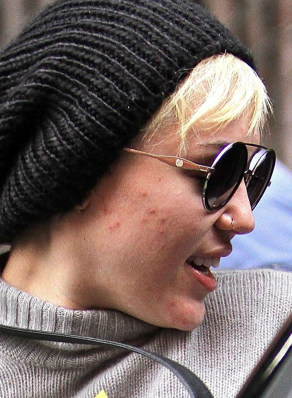 Acne Miley Cyrus