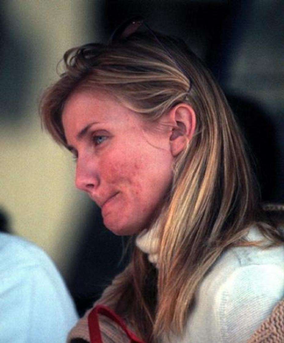 Cameron Diaz acne